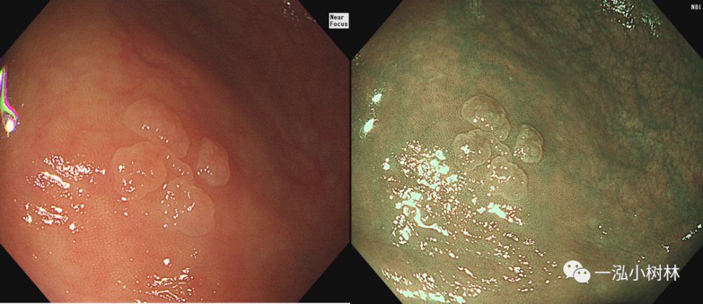 结肠NBI分类 内镜集锦
