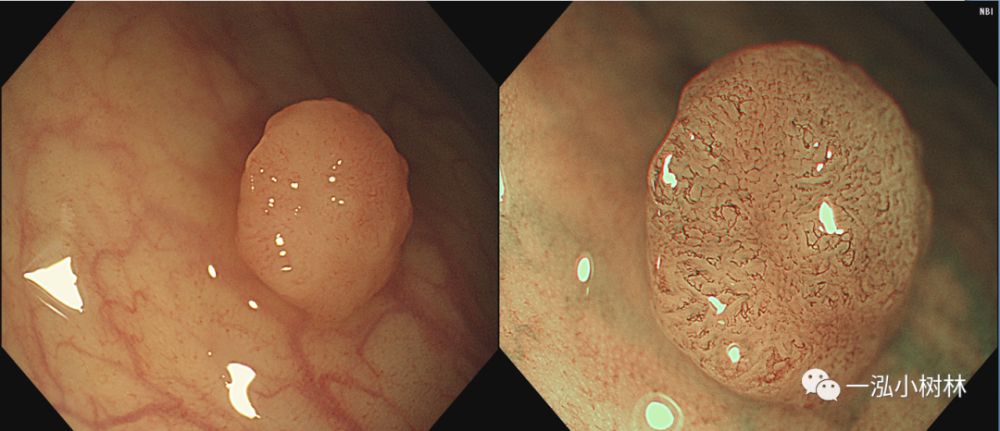 图40 结肠腺瘤(jnet 2a型)图41 结肠长蒂腺瘤(pit pattern iv iiis型)