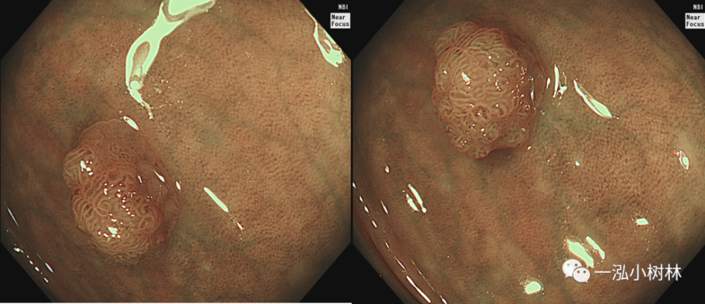 圖41 結腸亞蒂腺瘤(pit pattern iiil iiis型)圖42 結腸管狀腺瘤(pit
