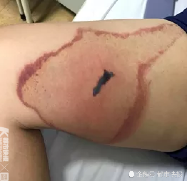 小夥被蜘蛛咬了一口大腿紅腫還發燒