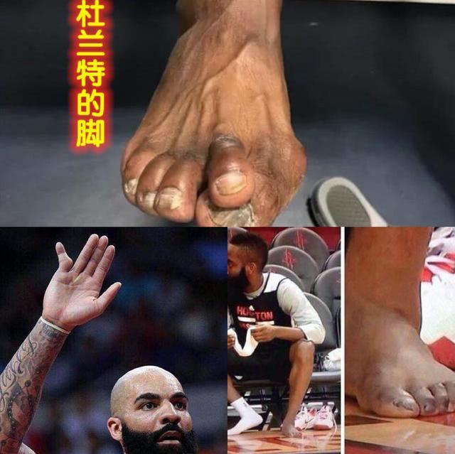 伤不起nba球员伤不起的手指脚趾