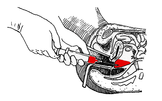 有的,这种办法就是后穹窿穿刺.