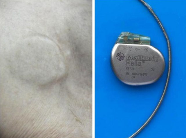 湖南地市级医院首例常德一医胶囊起搏器为八旬老人护心