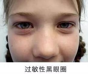 黑眼圈长久不消,可能是这些疾病在预警!