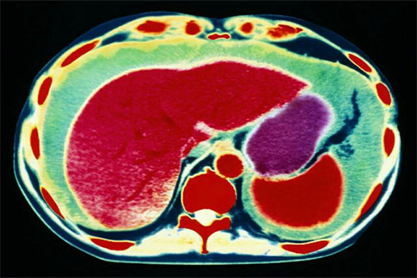 恶性腹水病因及病理生理学 恶性腹水 腹水 肿瘤