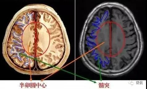 放射冠與半卵圓中心有哪些區別