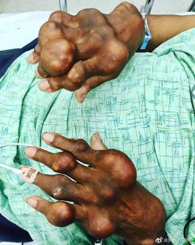 手指扭曲肿胀成这样,临床上真的很少见到……|痛风|医学界|关节痛