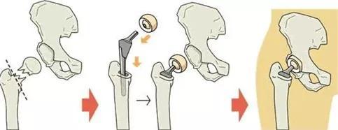名醫專訪 復旦大學附屬中山醫院邵雲潮:股骨頸骨折與髖關節置換(下)