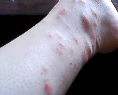 过敏|夏季皮肤过敏、奇痒无比？教你几个科学实用办法，轻松缓解没烦恼