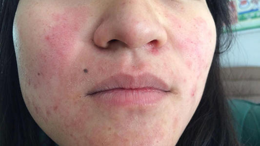 过敏|夏季皮肤过敏、奇痒无比？教你几个科学实用办法，轻松缓解没烦恼