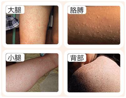 包含高考体检鸡皮肤怎么遮挡的词条