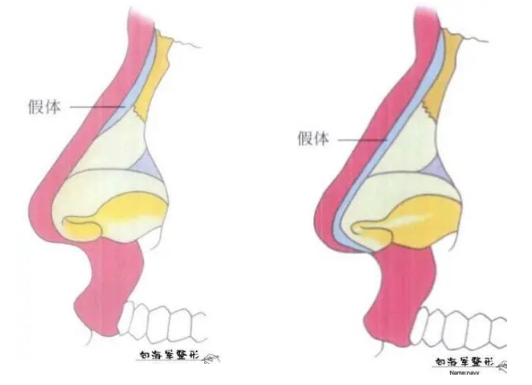 向海军医生:解惑:为何鼻整形术后鼻假体松动及透光?