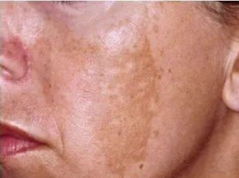 【女性】蝴蝶斑≠妊娠斑