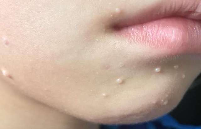 黄磊带女儿去医院治疗瘊子妹妹痛到哭喊再也不喜欢动物了