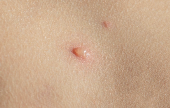 杭州70岁老伯下身长了20cm这东西,因"羞耻"不去医院,差点出了大事