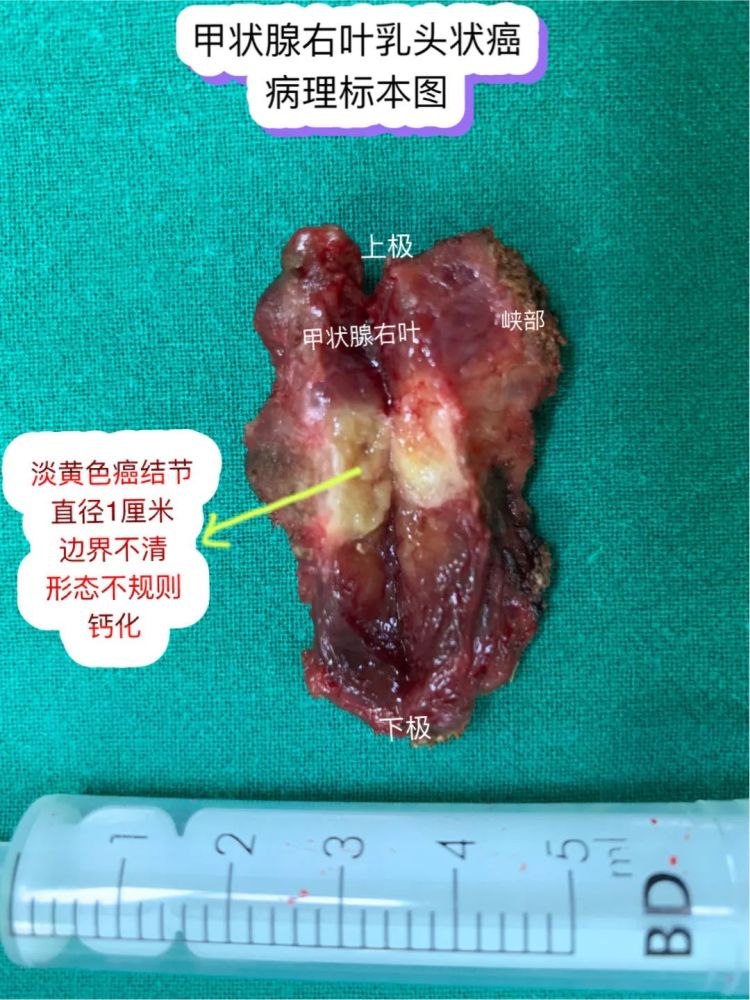 甲状腺b超过度检查会导致甲状腺癌高发吗