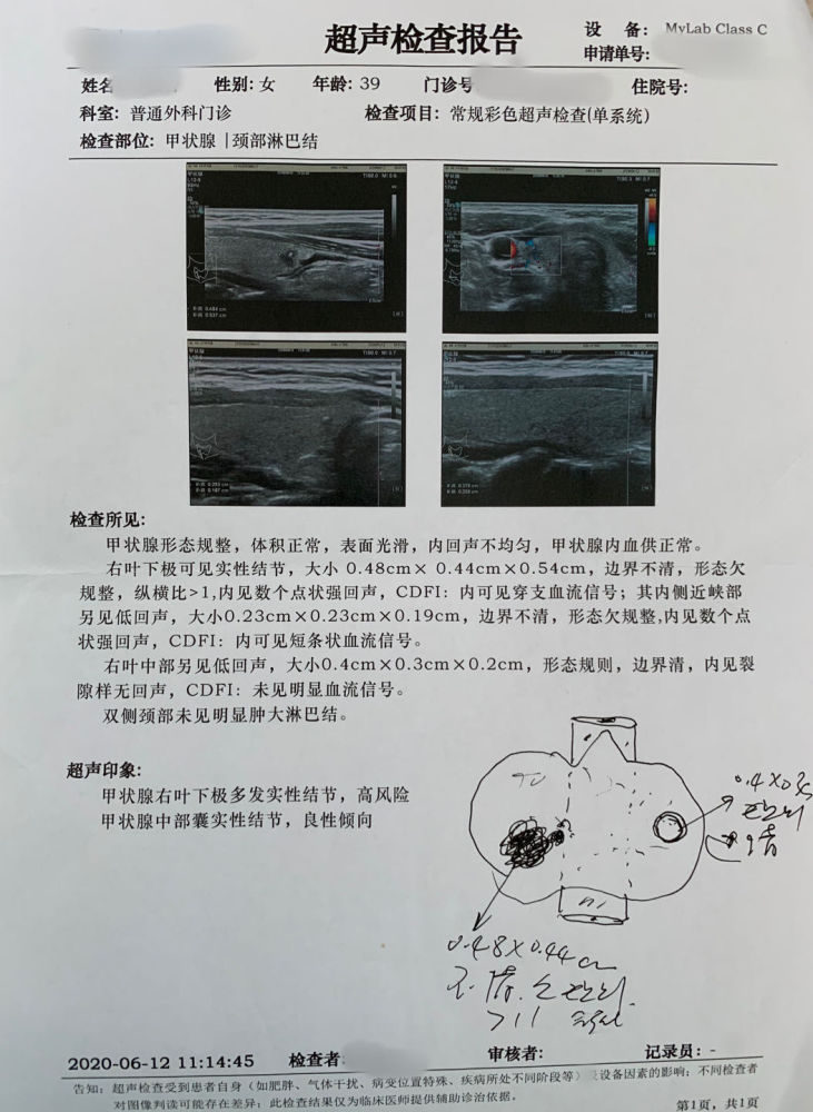 甲状腺彩超上中下极图图片