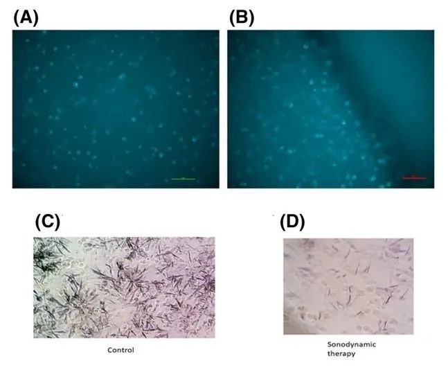 脑膜瘤|脑科学日报：超声有望治疗最致命的脑瘤；焦虑为何会让你发胖？
