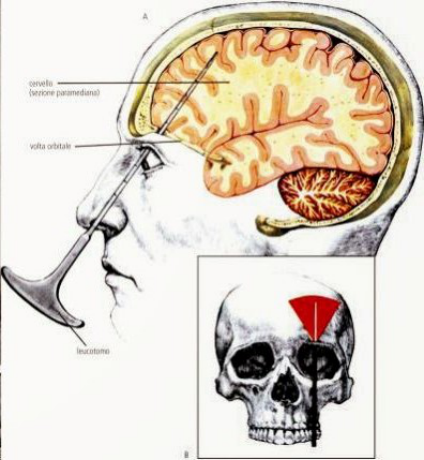意识|左右半脑各自有独立意识？大脑：我裂开了