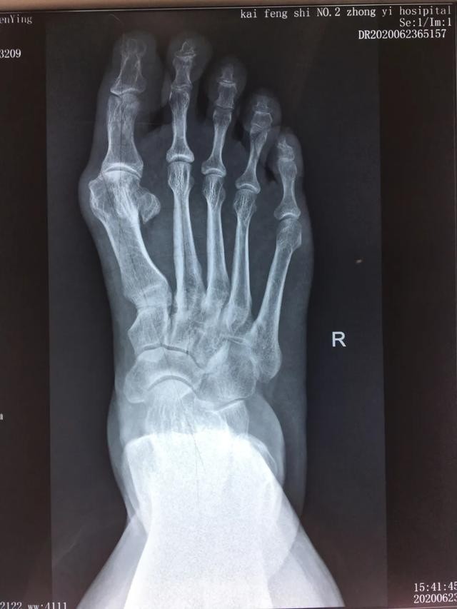 入院后,通过对患者双足负重下的正侧位x片的足趾畸形力线研究分析,经