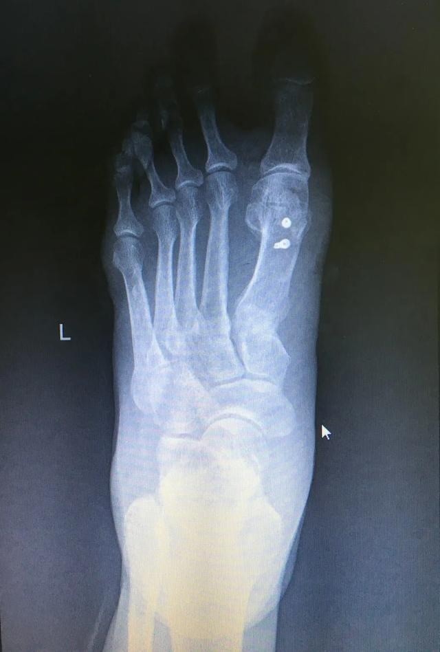 足底行走痛 原来是"大脚骨"惹的祸