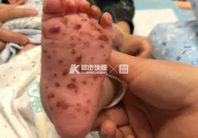 点状皮疹;第二天皮疹增多,不仅脸上,口腔周围,还有双手都出现了疱疹