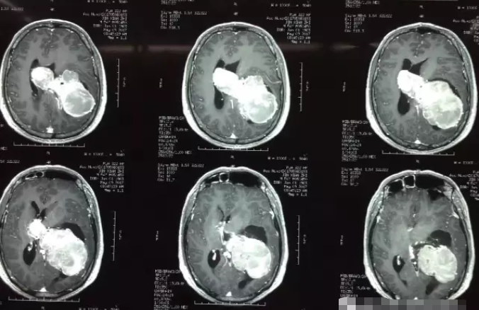 低級別膠質瘤半年內長大迅速惡化腦瘤手術等不起