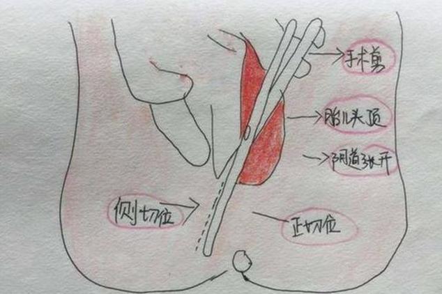 順產過程中側切和撕裂差在哪也許和大家想的不一樣