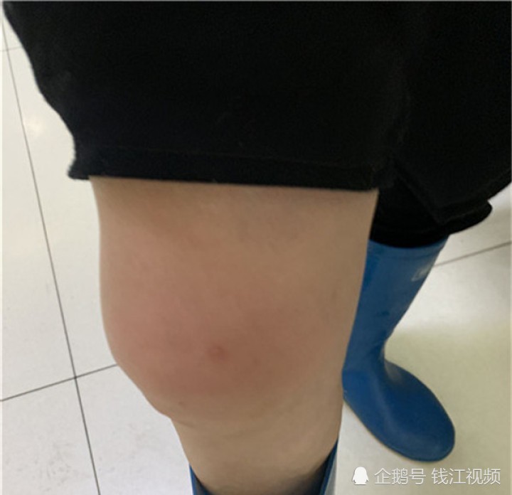 今天下午杭州一对老夫妻在茶园被马蜂咬伤!大伯送医时已休克