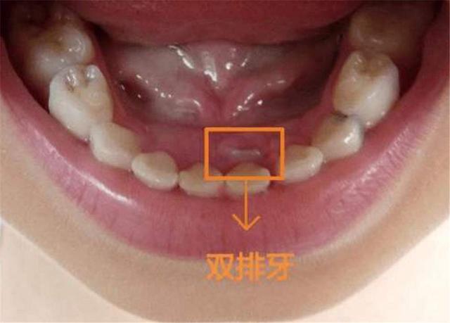 通過仔細的觀察,她發現孩子牙床上的恆牙已經長出了1顆,但前面的乳牙