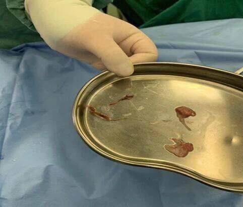 陈医生称,对于医生来说,拔鱼刺这种事有时候是要靠运气的,鱼刺可能就