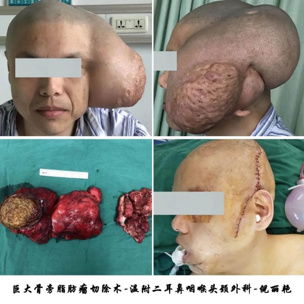 罕见脑袋上长了34斤的巨大脂肪瘤温州小伙20多年的困扰终于解决