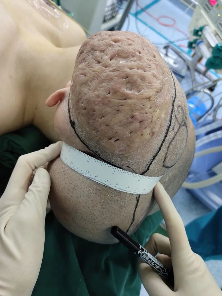 罕见脑袋上长了34斤的巨大脂肪瘤温州小伙20多年的困扰终于解决