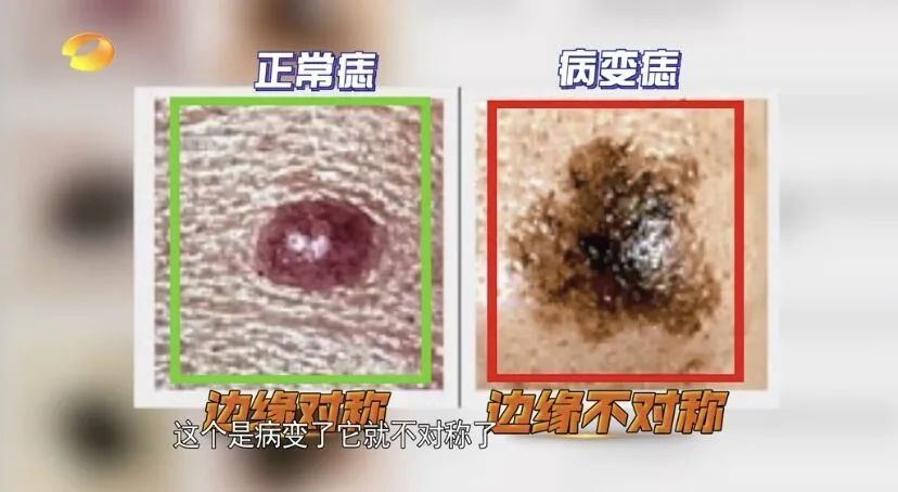 有痣青年们警惕这几种痣可能黑化成瘤