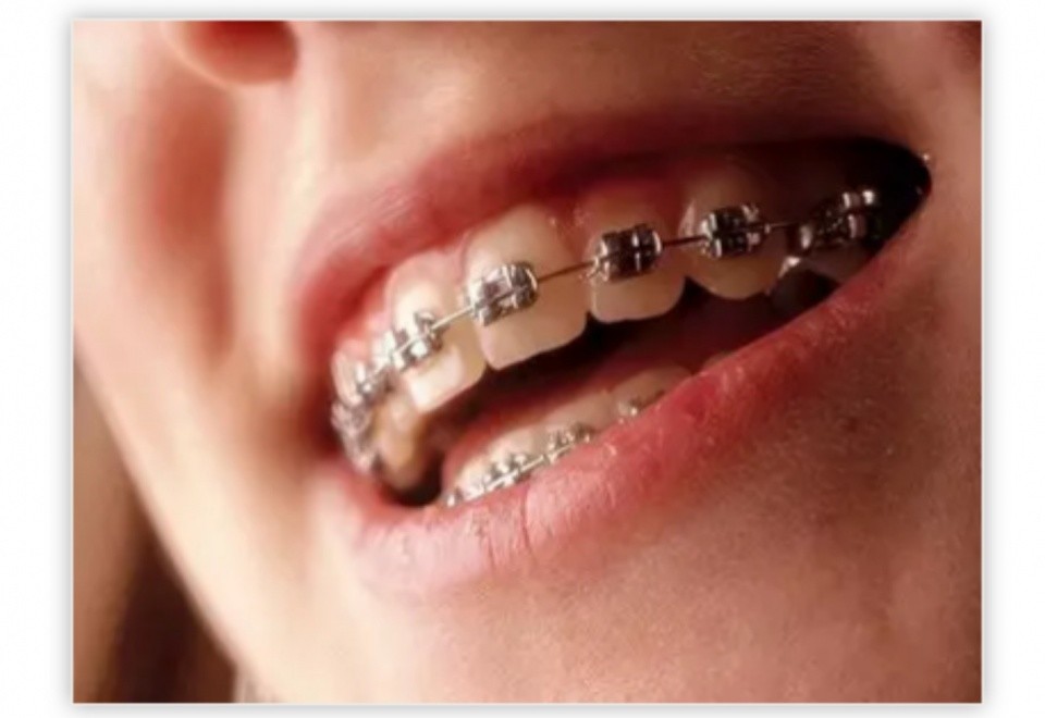 1,金属托槽矫正