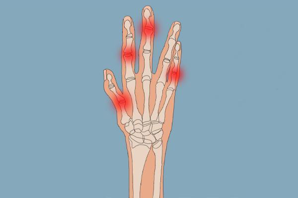 肺不好手会露出丑态若已全部出现可能肺已烂如渔网