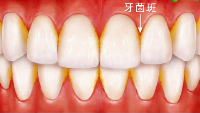 图 黑色的牙菌斑怎么去除呢11个妙招让你拥有洁白牙齿