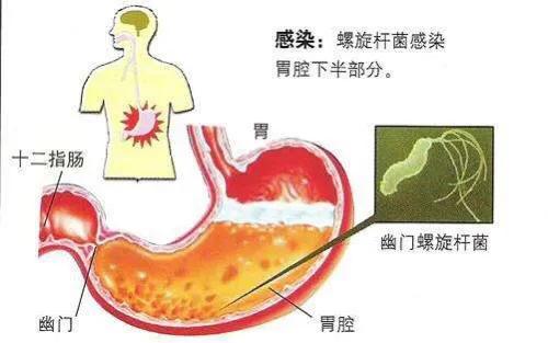 幽门螺杆菌阳性是什么意思?