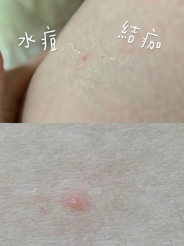 男孩染水痘出紅疹被當成蕁麻疹治療險併發腦膜炎