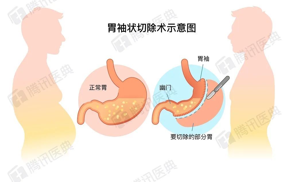 手術減肥_減肥手術哪種方式最好_減肥手術多少錢