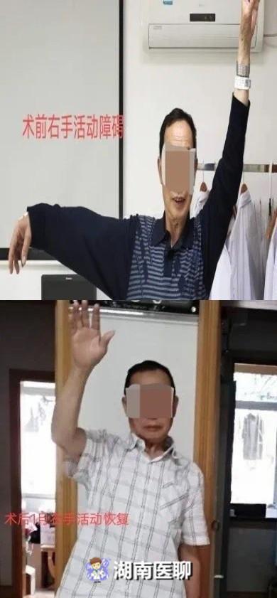 肩周炎|肩痛＝肩周炎？错！六成以上的肩痛都是因为这种病，别再耽误治疗