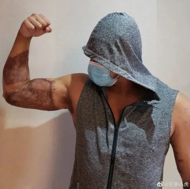 港警"小虎sir"解开纱布的这一幕,太心疼!