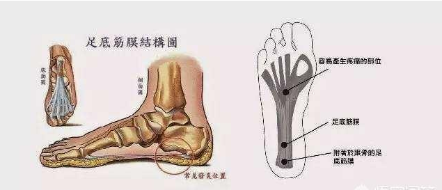 足底筋膜炎 治疗方法图片