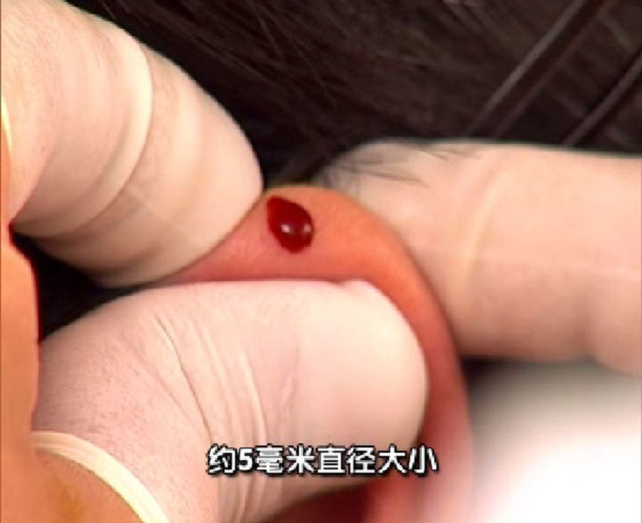 神奇的耳尖放血疗法,你知道多少?【收藏篇】_腾讯新闻