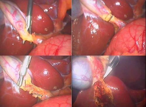 腹腔镜下胆囊切除与保胆取石术