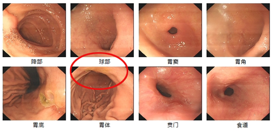 早发现早治疗,这样的新辅助治疗成为进展期胃癌患者的福音!
