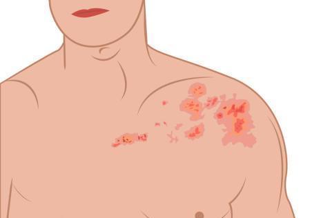 带状疱疹疫苗|带状疱疹疫苗上市，哪些人适合接种？这些知识可以先了解一下