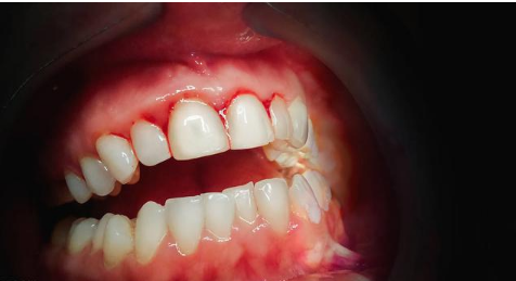 严重的坏血病会出现开放性的溃烂伤口,以及掉齿,最终导致死亡.