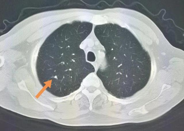 什么样的肺结节要及时处理不然容易癌变