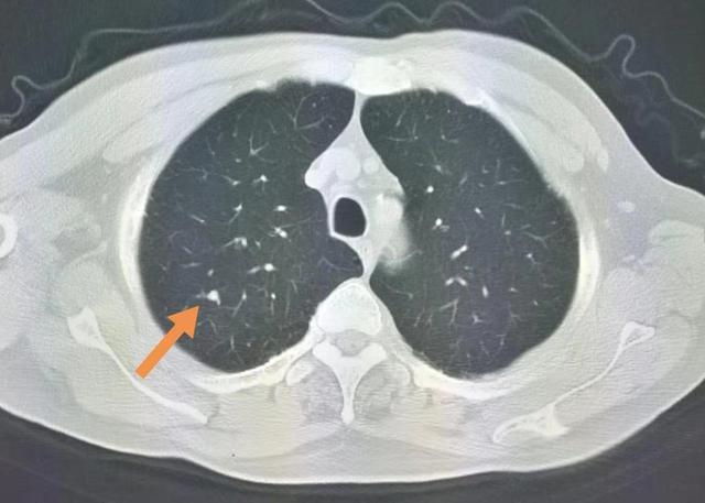 良性肺结节ct图图片